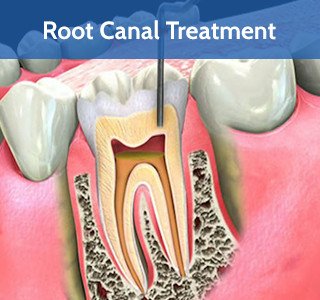 Root Canal Treatment