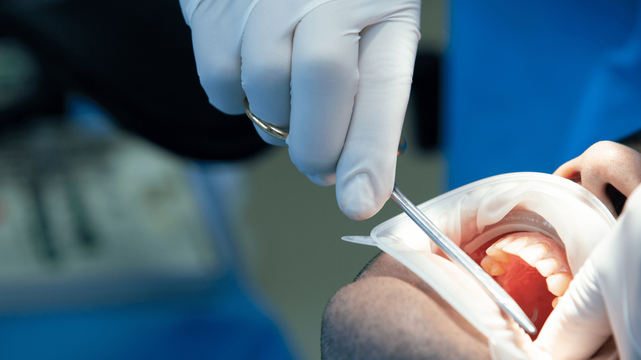 periodontal flap surgery-min